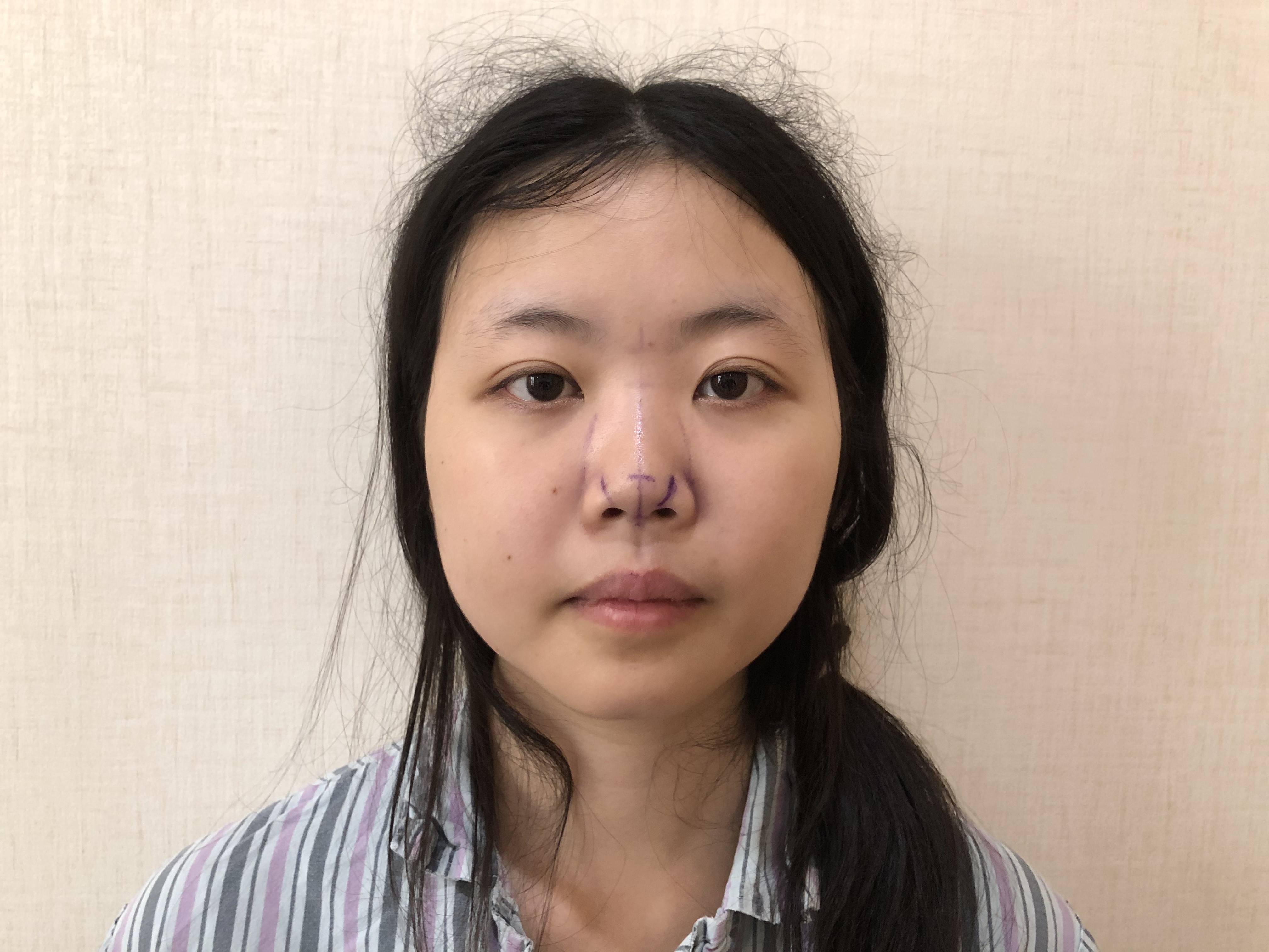 透过照片,这位求美者鼻部的问题是鼻头,鼻小柱较短.