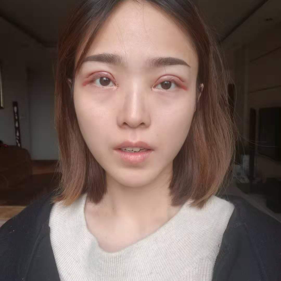 今天是做完双眼皮手术的第三天