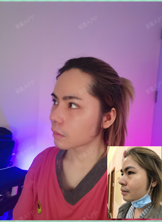 鼻部多项第47天广州艺美李闯院长