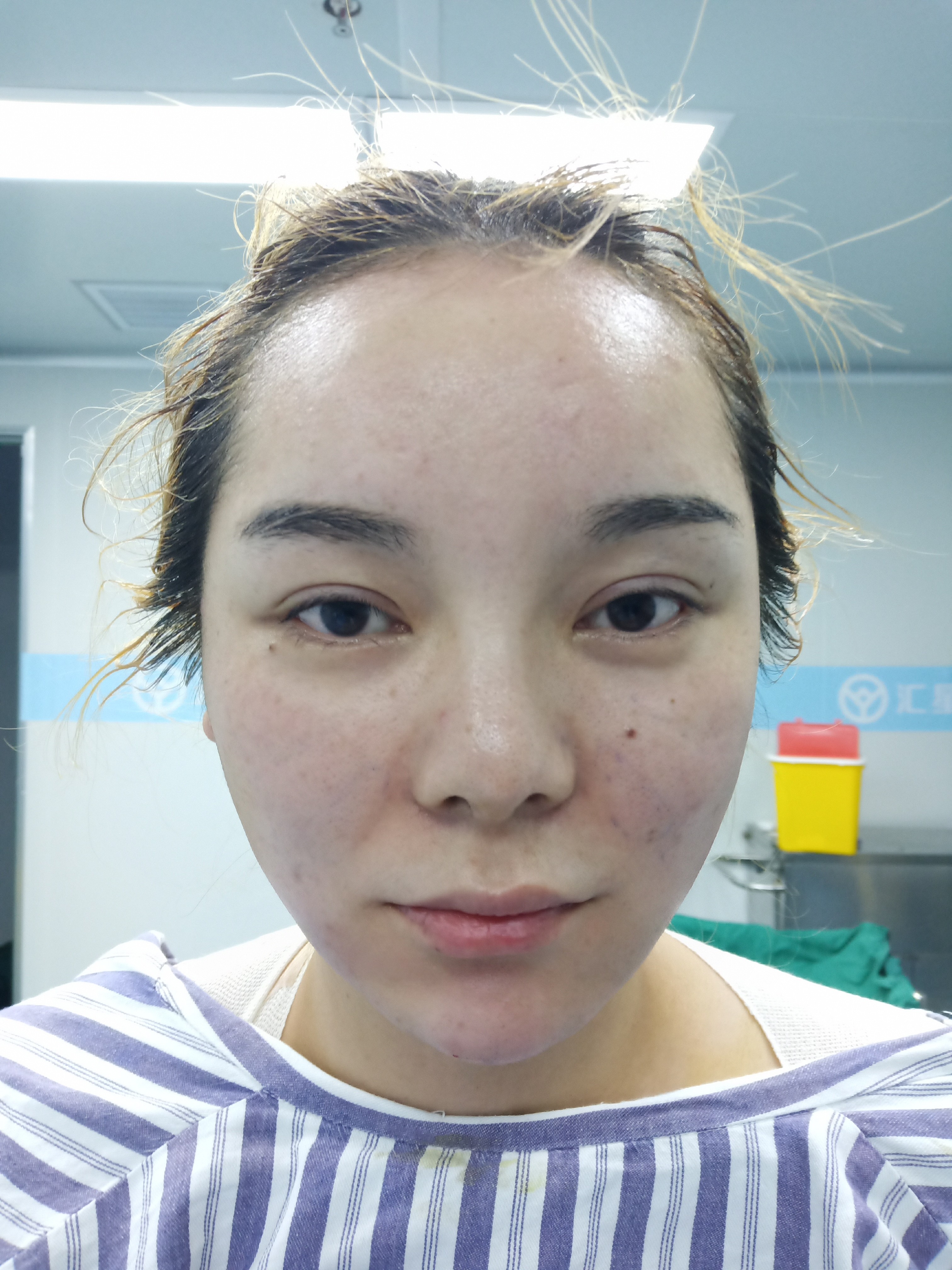 面吸术后即刻效果对比面吸口角囊袋/下颌缘,即刻见效_圈子-新氧美容