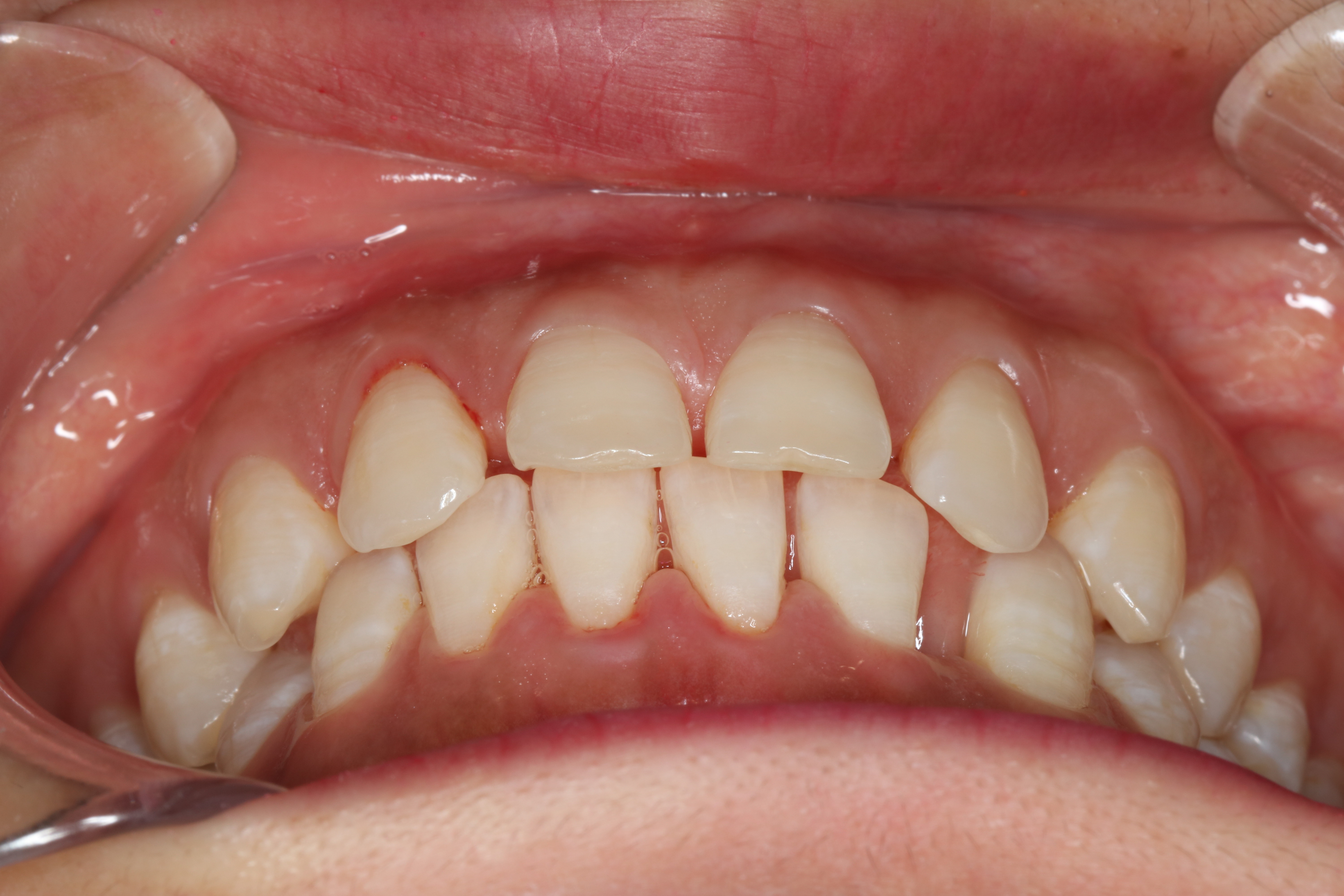 我的牙齿是属于深覆合的那种,而且牙齿非常的不整齐,_圈子-新氧美容