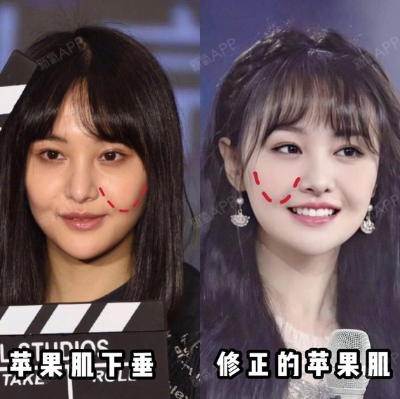 不断层的苹果肌才是少女感的关键75157515苹果肌下垂会_圈子