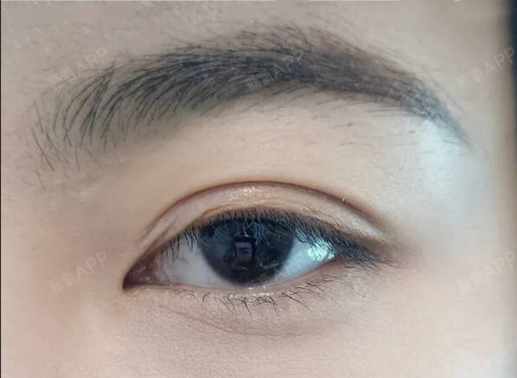 肿泡眼又称肉泡眼,水泡眼,肉里眼.