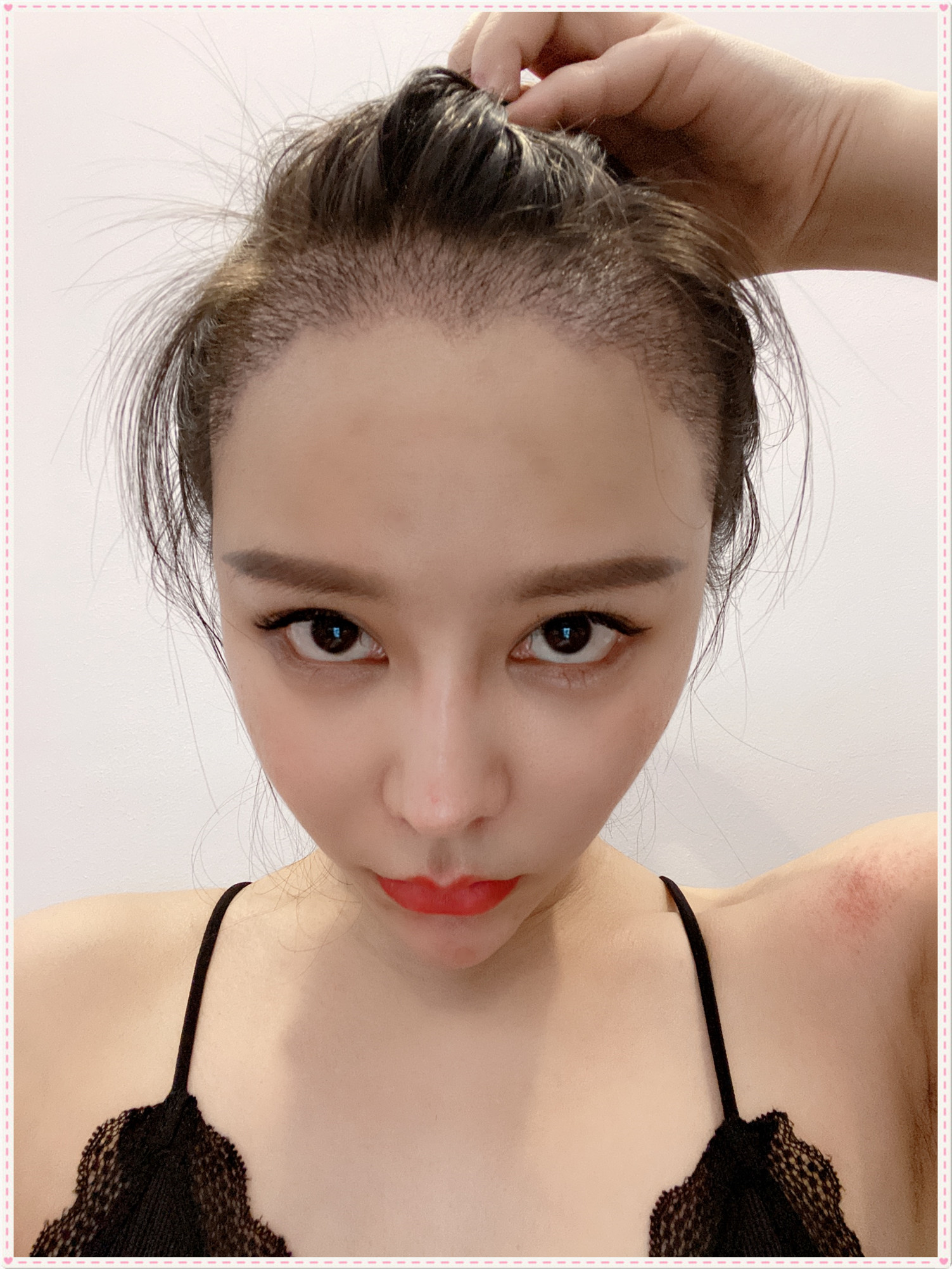 【首瑞植发日记——术后半个月记录】半个月过去了,发_圈子-新氧美容