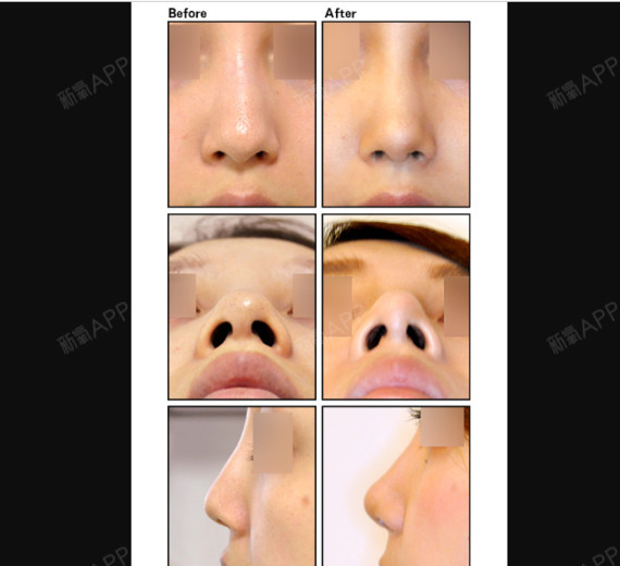 鼻中隔延长对比照片图片