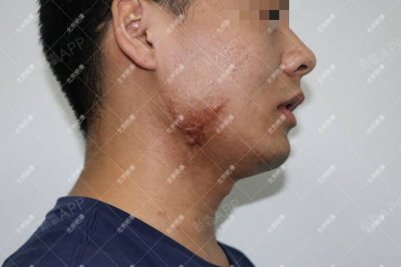 这位男士下颌部患瘢痕疙瘩多年,经历过很多方法治疗病