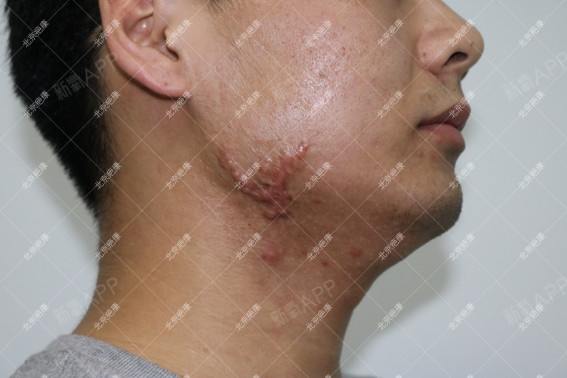 这位男士下颌部患瘢痕疙瘩多年,经历过很多方法治疗病