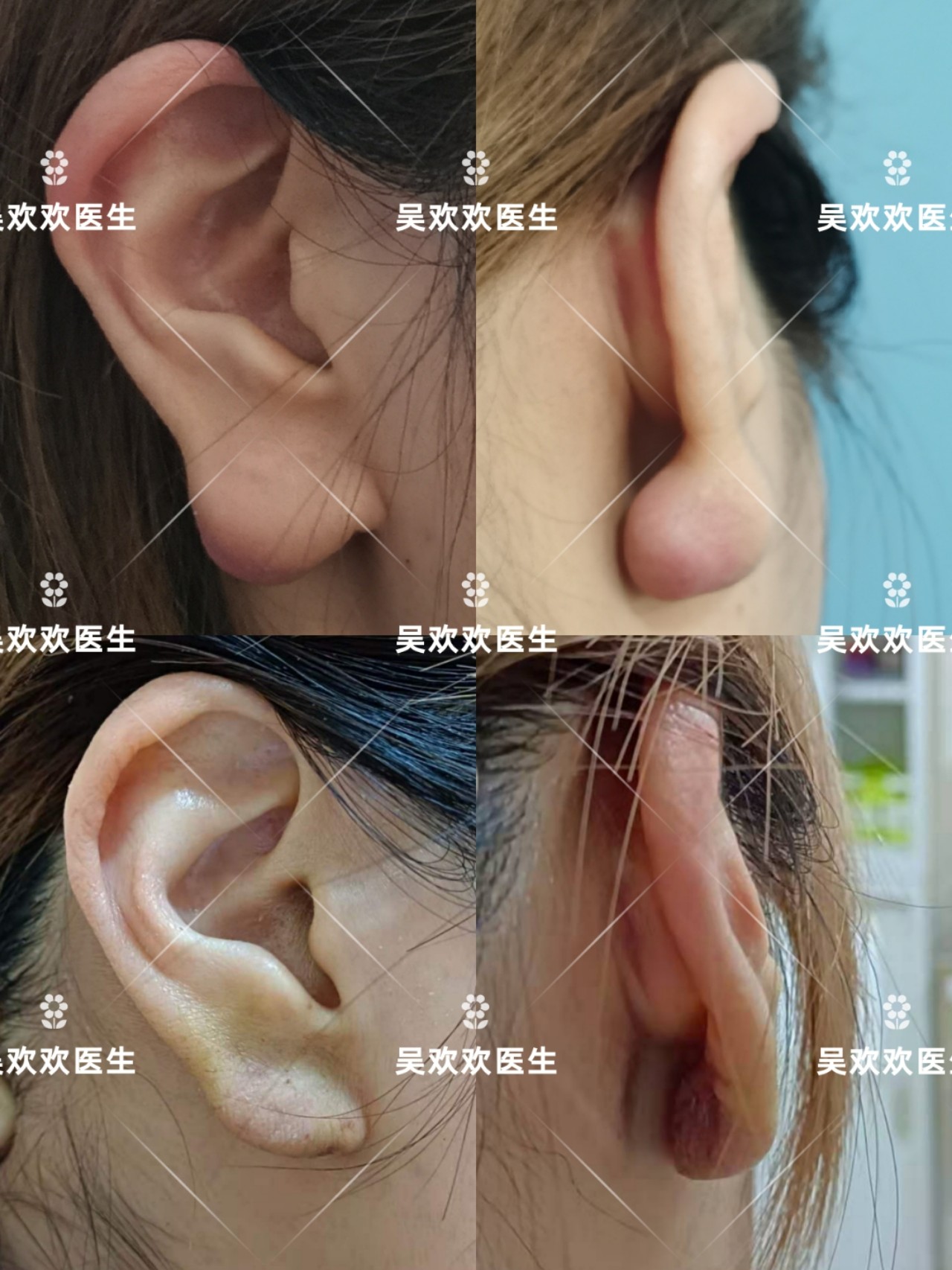 穿孔术后瘢痕疙瘩增生耳垂瘢痕疙瘩反复增生已经是_圈子-新氧美容整形