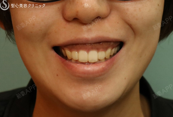 今天给大家介绍一个露龈笑治疗的案例露龈笑治疗