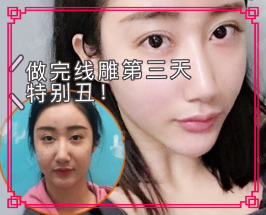 亲妈吐槽做完线雕第三天特别丑,做好面部线雕术后护理_圈子-新氧美容