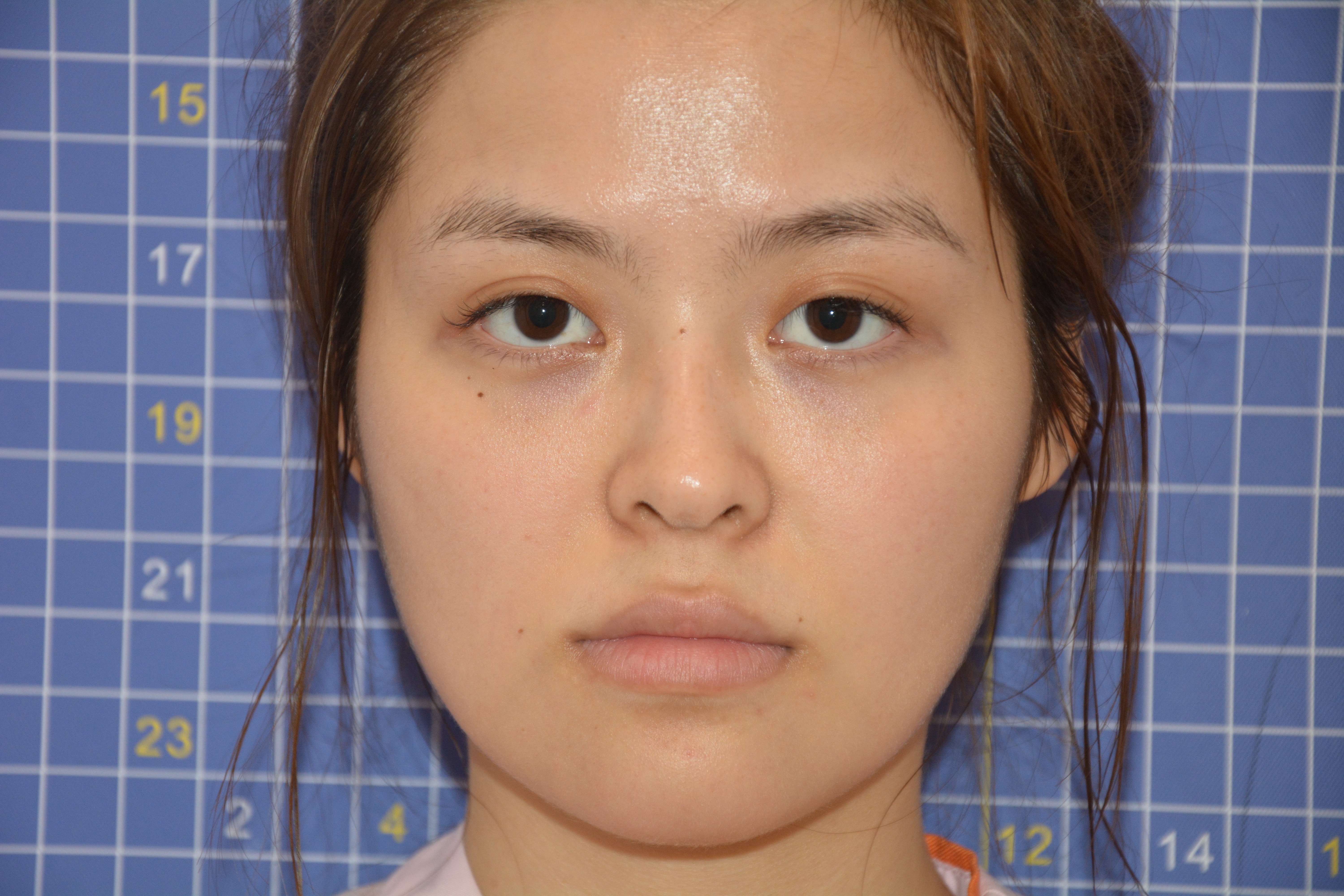 术前太阳穴泪沟有轻微凹陷,侧面看面部没有起伏,影响_圈子-新氧美容