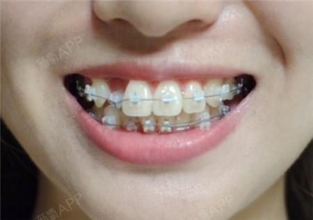 大连齿医生口腔科普大连门牙缝隙大矫正多少钱