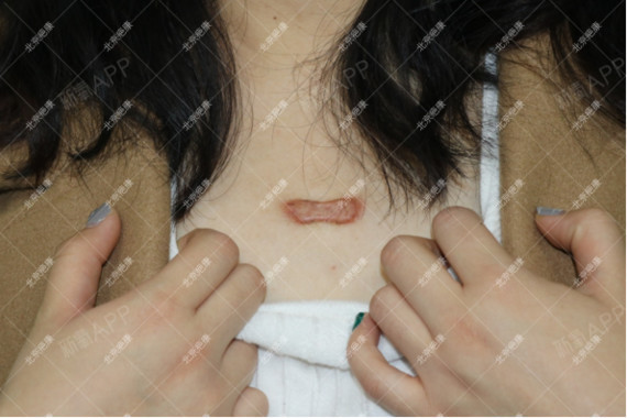 该女士前胸部患瘢痕疙瘩多年,曾采取多种治疗方法治