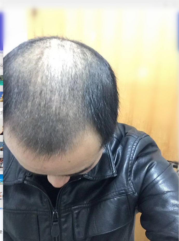 植发两个月了,还没过置换期,头发掉了很多,灯光下看_圈子-新氧美容