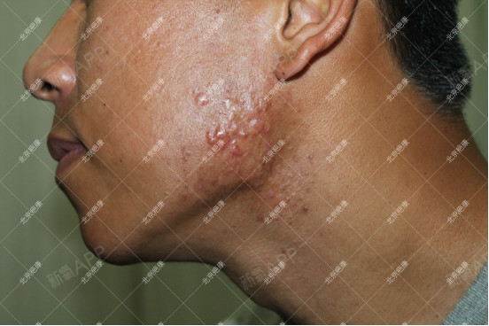 这位下颌部位瘢痕疙瘩较多,但较轻,治疗后得到了比较理想的满意效果.