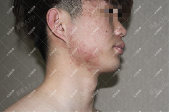 腮腺混合瘤手术后疤痕图片