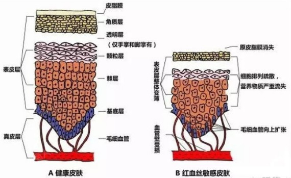 臉上有紅血絲不一定是角質層薄