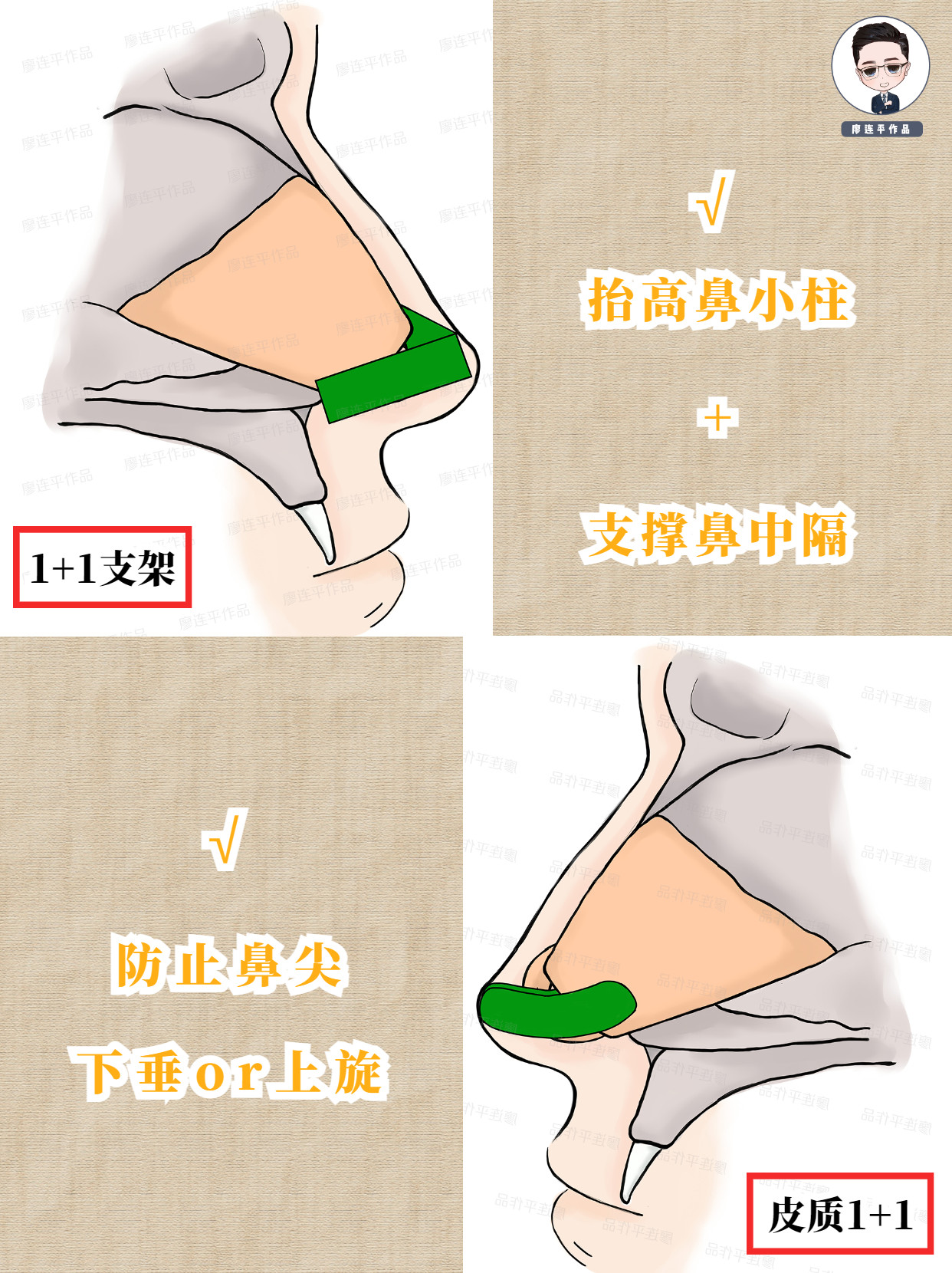 鼻整形支架大解析二