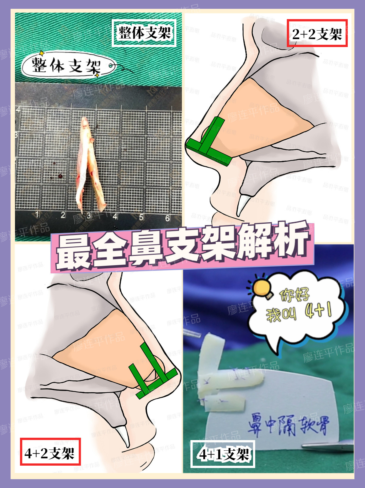 鼻整形支架大解析二