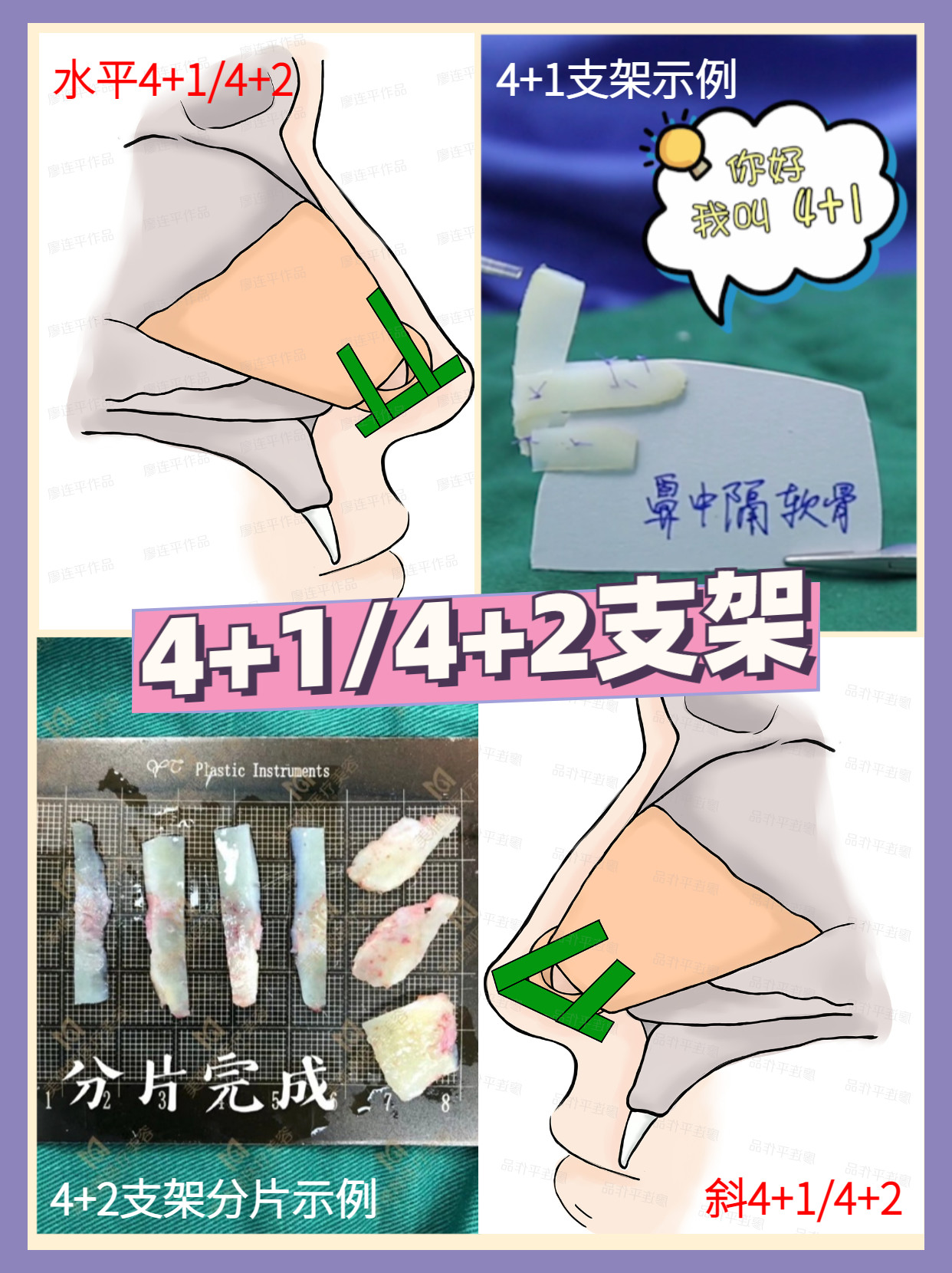 鼻整形支架大解析二