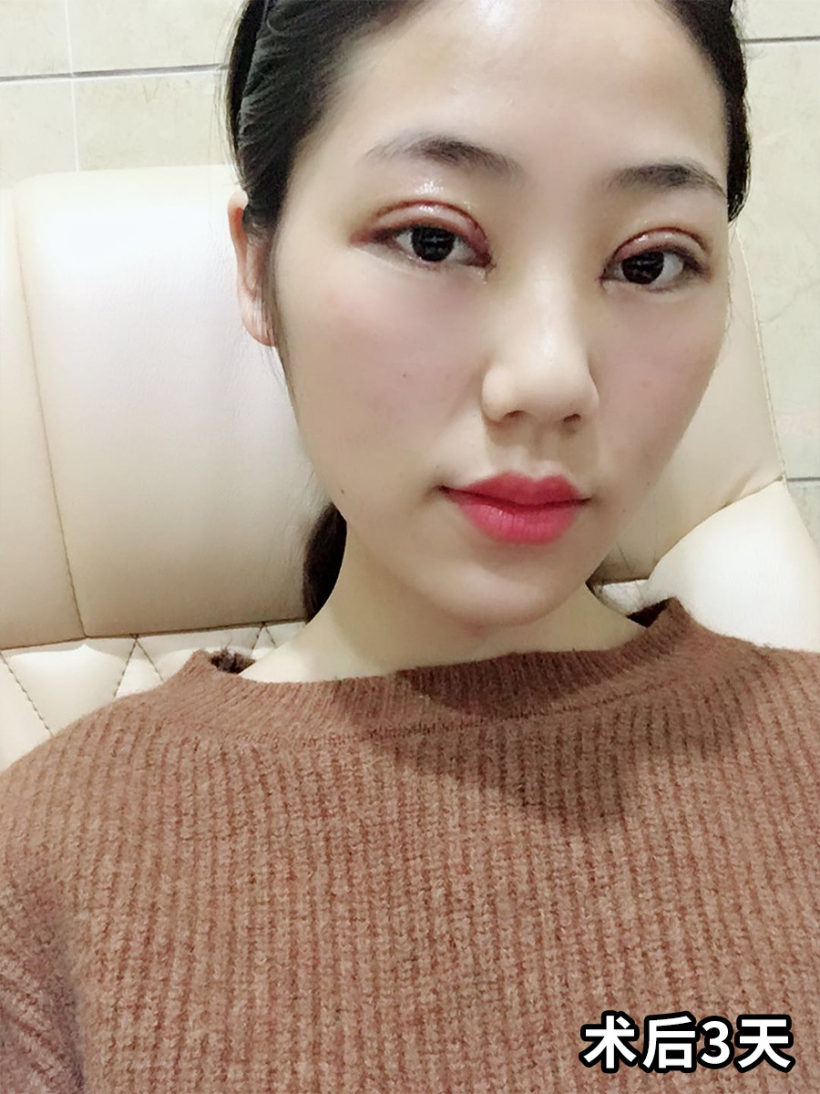 一个月后丹凤眼女孩变成灵动大眼!