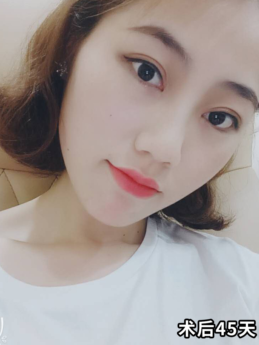 一个月后丹凤眼女孩变成灵动大眼