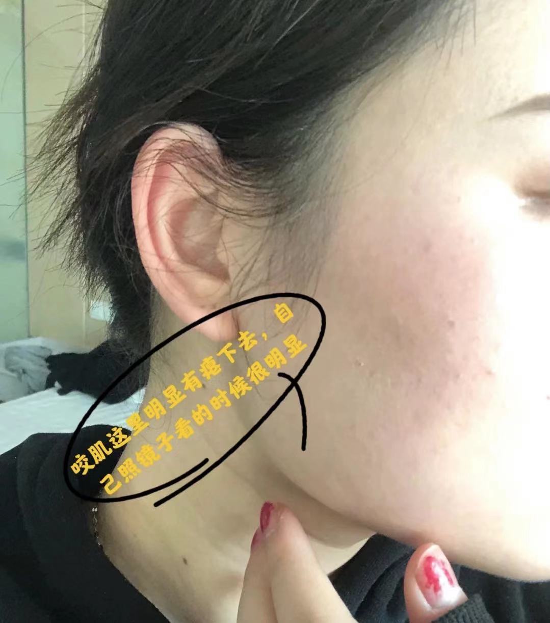 瘦脸针打完第四天了,真的是有变化哎,针眼已经是愈合了.