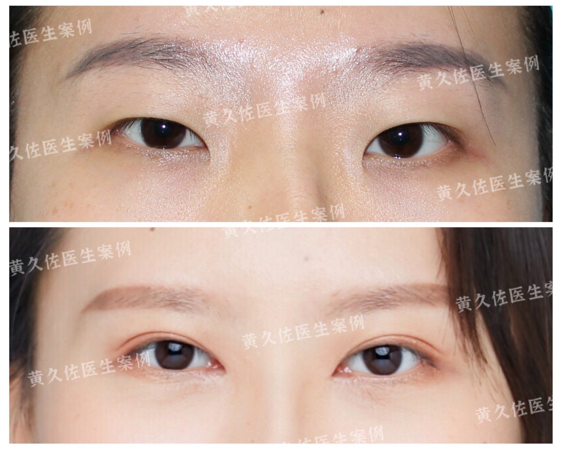 术前单眼皮内眦赘皮比较严重