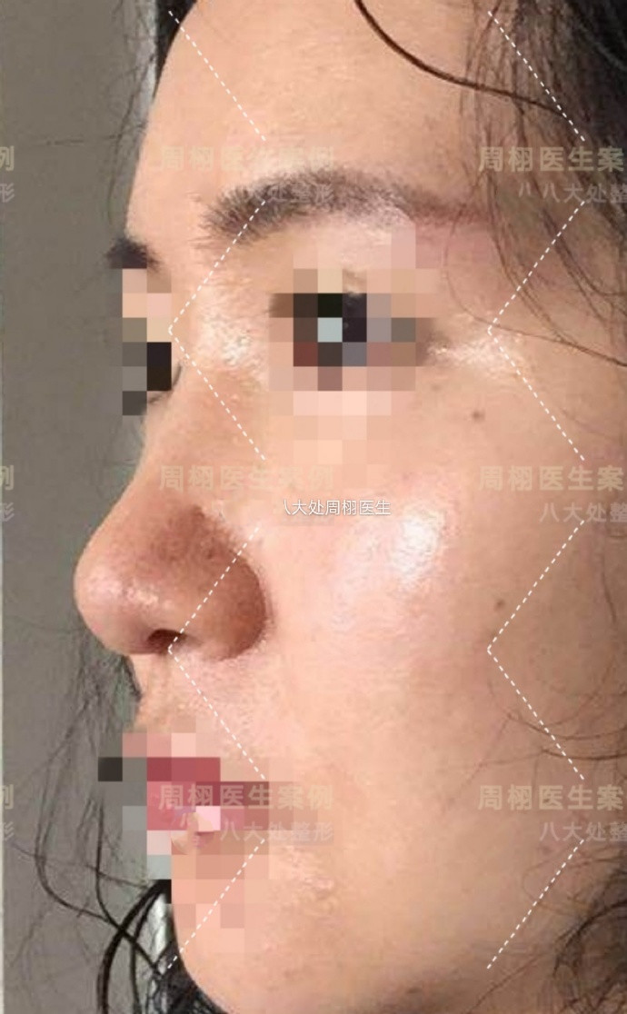 患者初鼻基础差,鼻头肥大,塌陷,鼻小柱短小.肋软骨_圈子-新氧美容整形