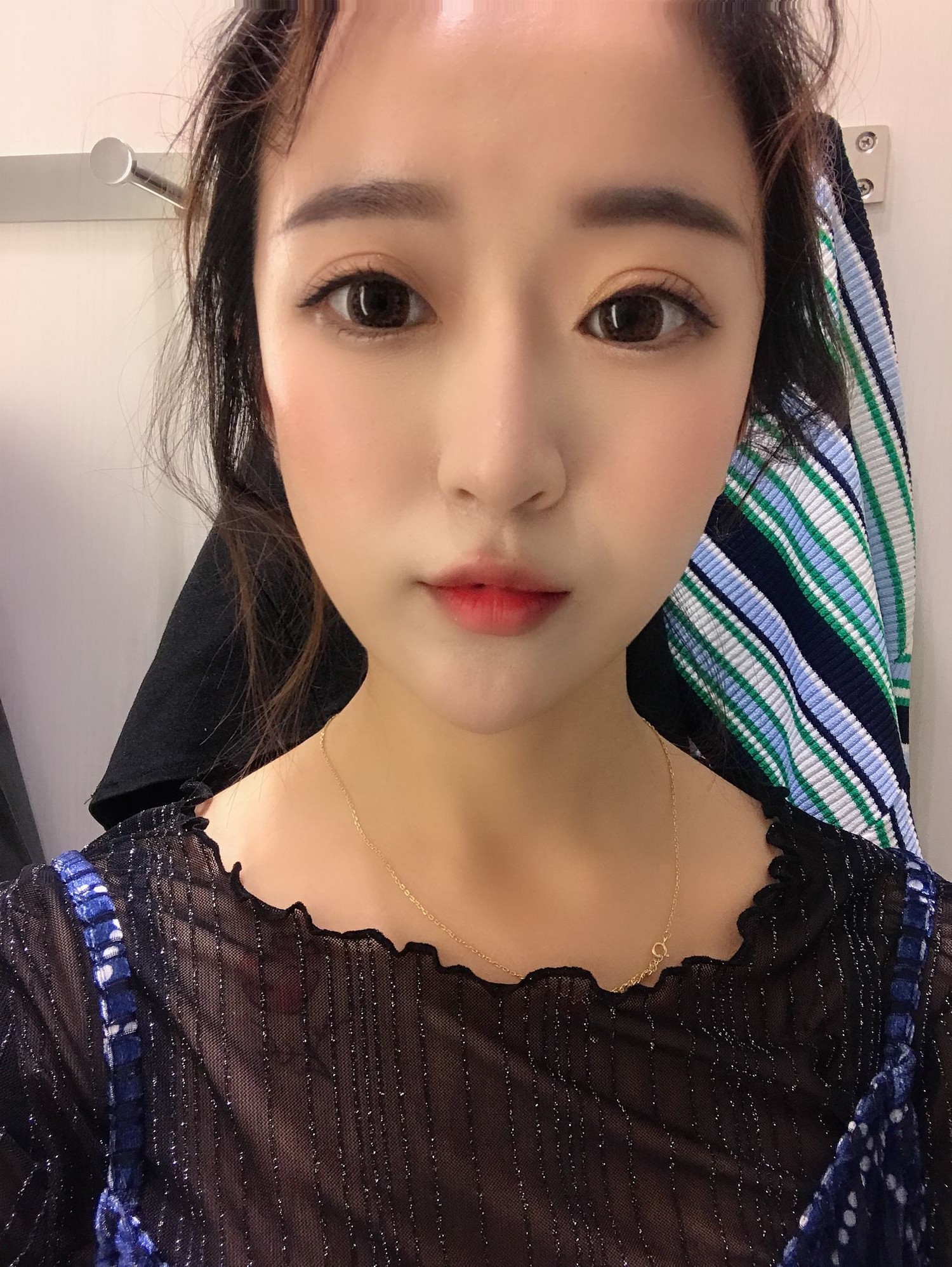 【双眼皮精雕】术后30天