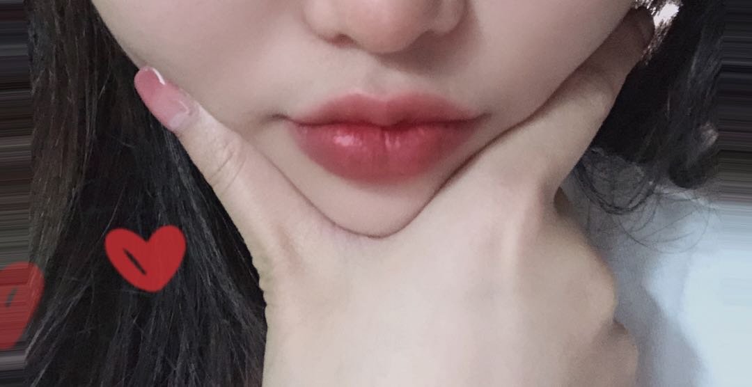 的上唇偏厚且有些许外翻,下唇唇线较平,也无唇形,_圈子-新氧美容整形