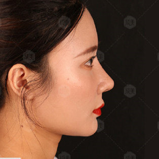 患者术前初鼻基础差,鼻宽,山根低平,鼻翼肥大,鼻头_圈子-新氧美容整形