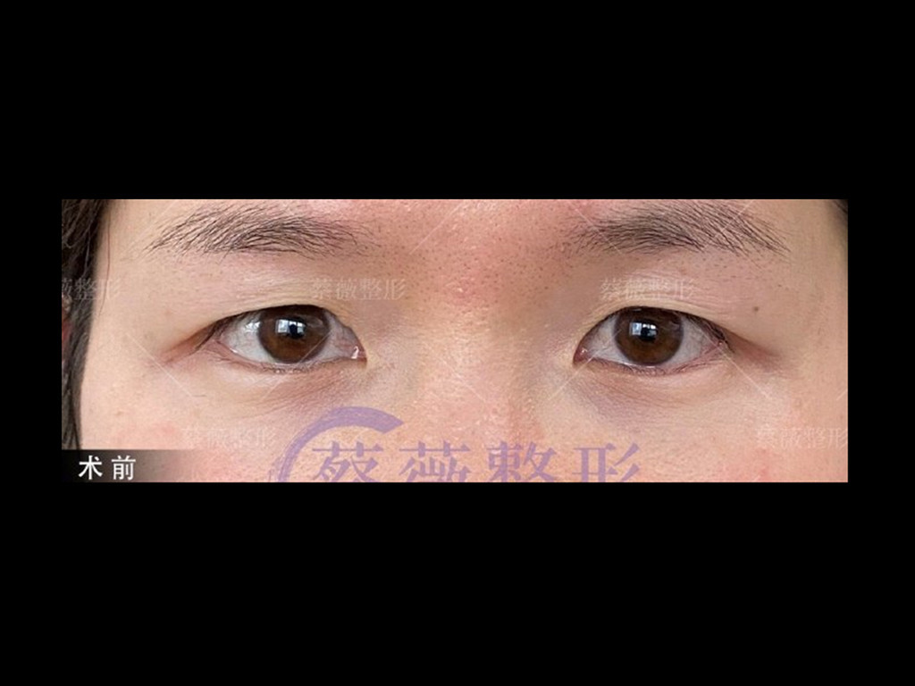 患者术前呈较明显的三角眼,不仅是皮肤松弛,也是天生_圈子-新氧美容