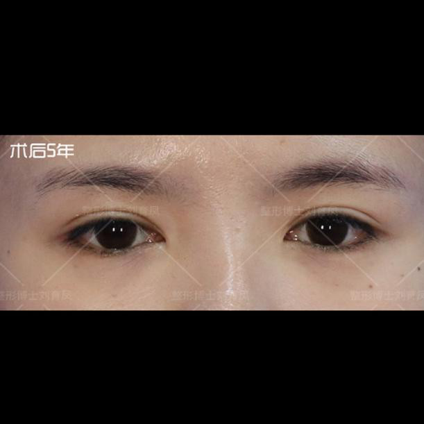 术前三角眼重脸 内眦赘皮矫正术后双眼皮宽度不宽,但_圈子-新氧美容