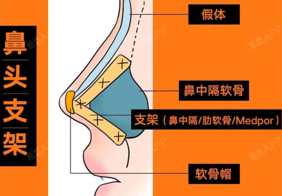 (图片出自薛宏宇) 说道支架就要提到鼻棘,就是这个位置