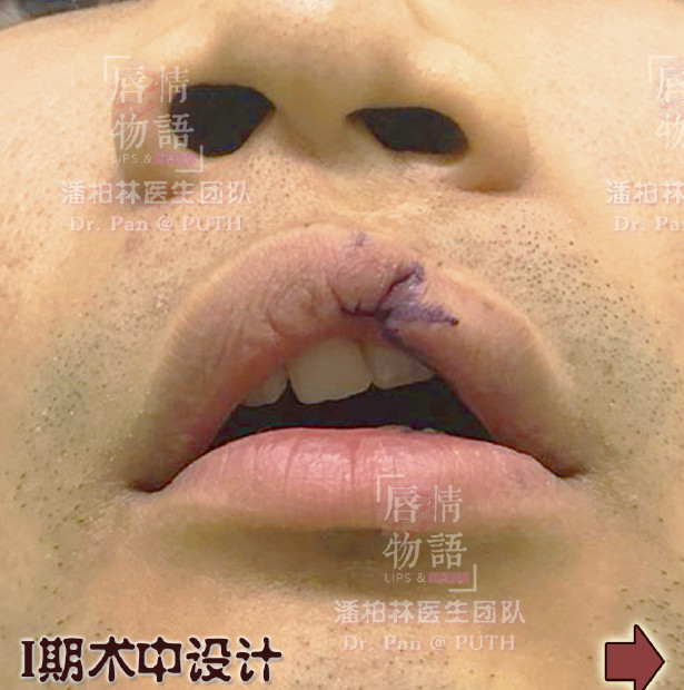 男,25岁,先天性左侧唇裂,幼儿期进行首次修复后,成年