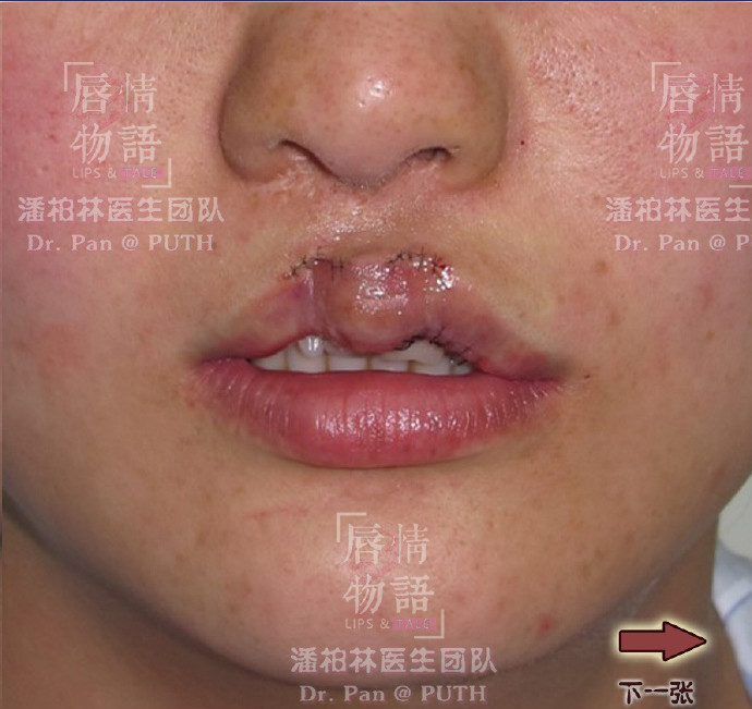 女,28岁,单侧唇裂修复术后,主要表现为唇峰,唇谷