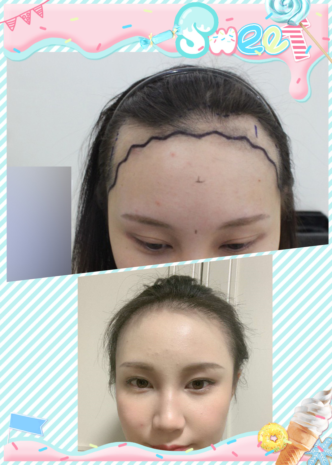 大麦微针植发·术后3个月