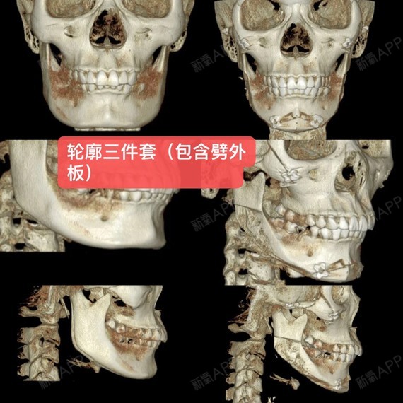 下颌角劈外板颧骨内推终于变小脸了