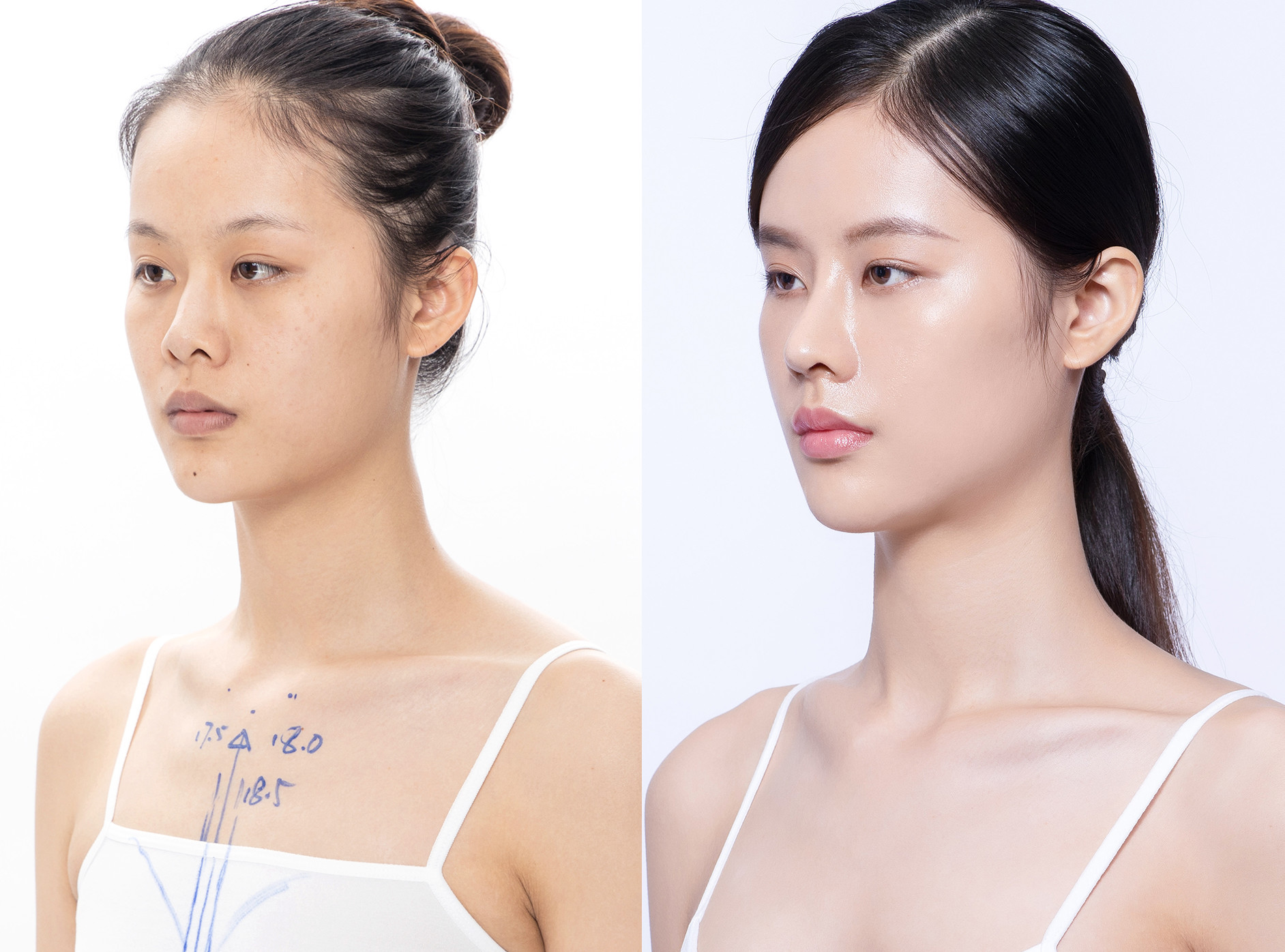 【术前诊断】初鼻,漏鼻孔,鼻梁比较塌 ,鼻翼缘退缩,整个面部