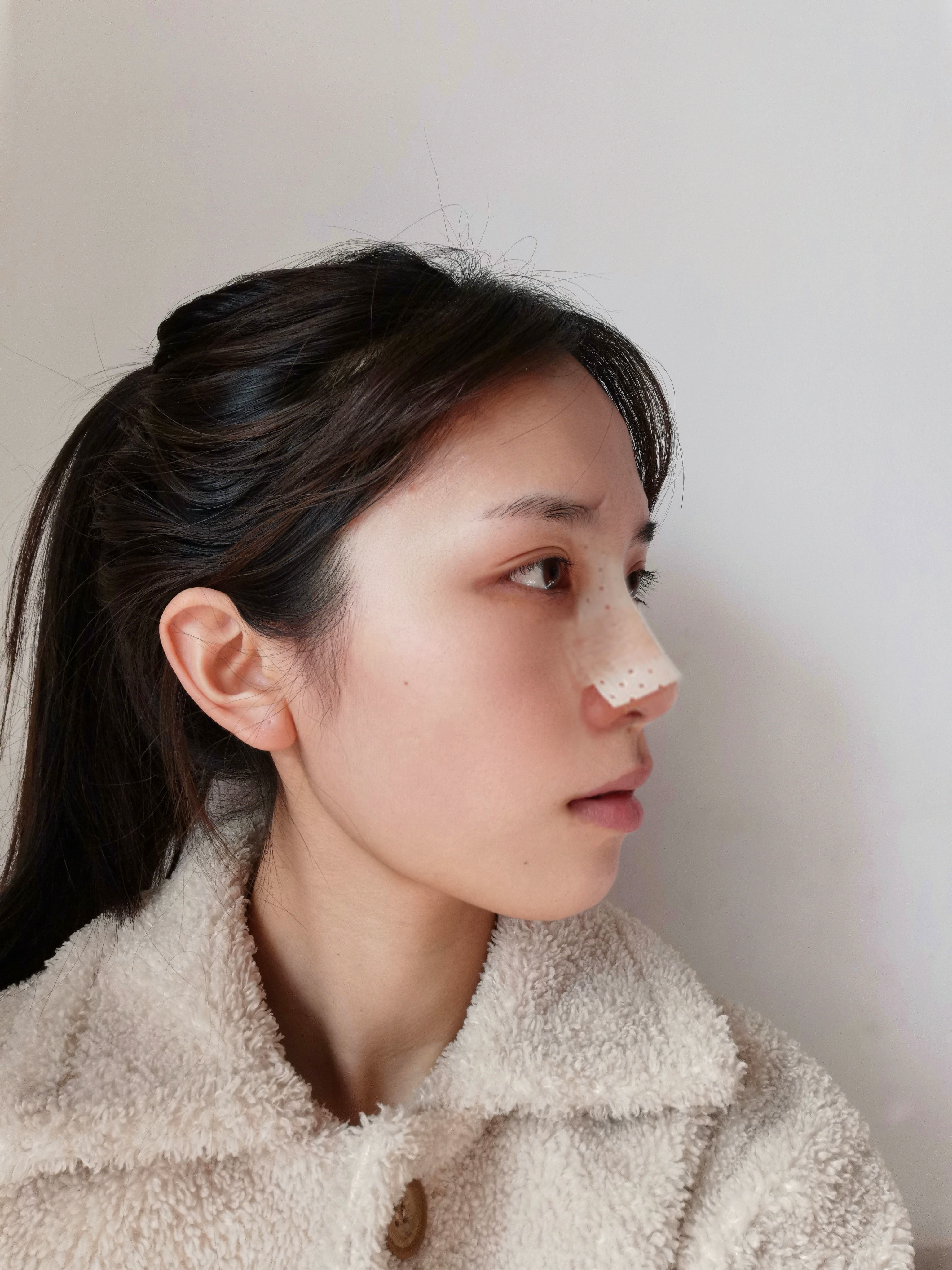 【术后第二天】有宝宝问我要刚做完手术的样子,那我这_圈子-新氧美容