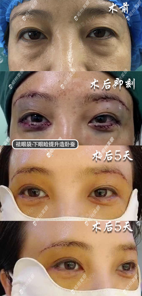 郑州美眼整形眼袋真的可以变卧蚕吗卧蚕效果不笑的时候也有吗