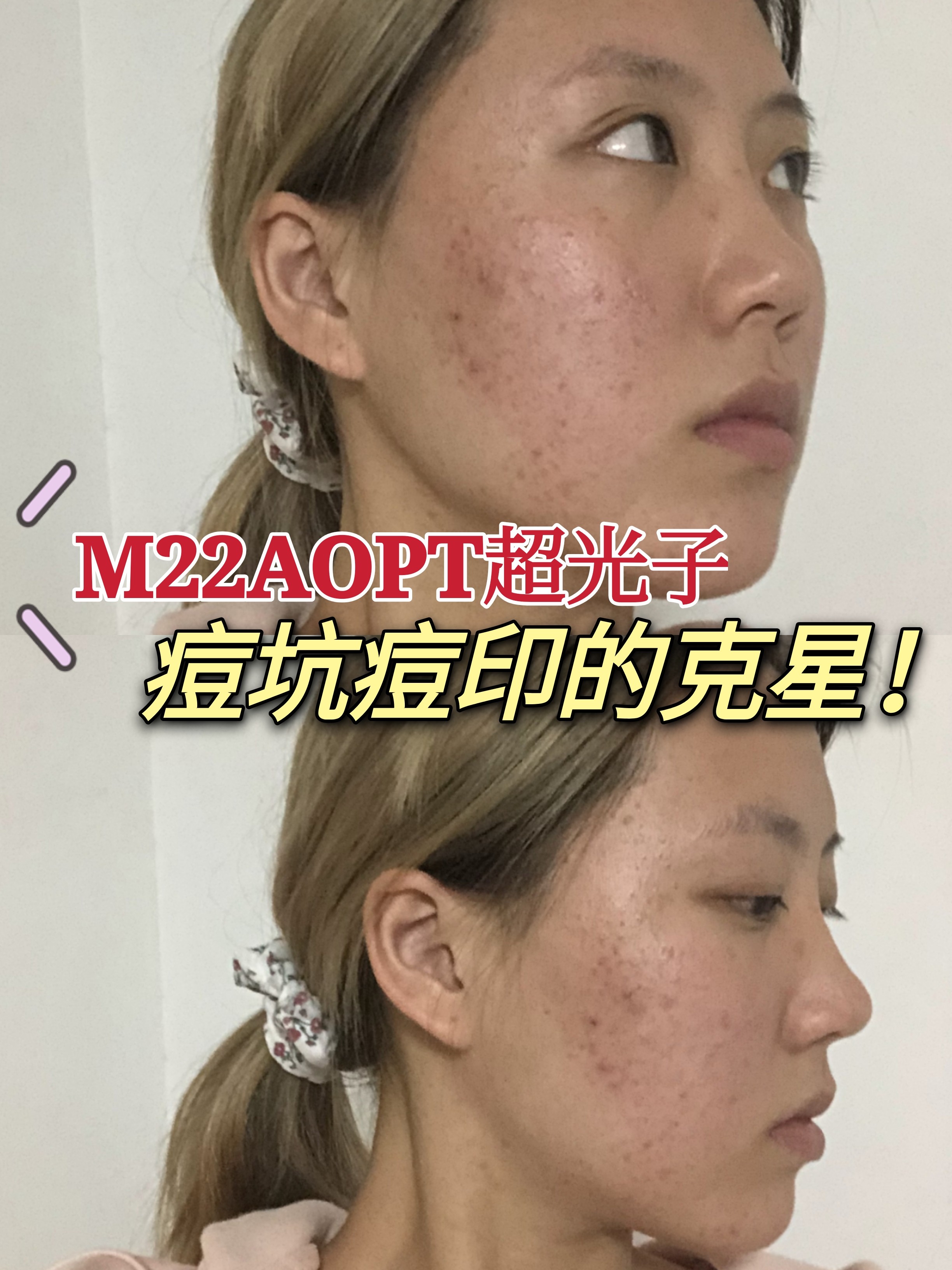 m22超光子让痘坑痘印的克星