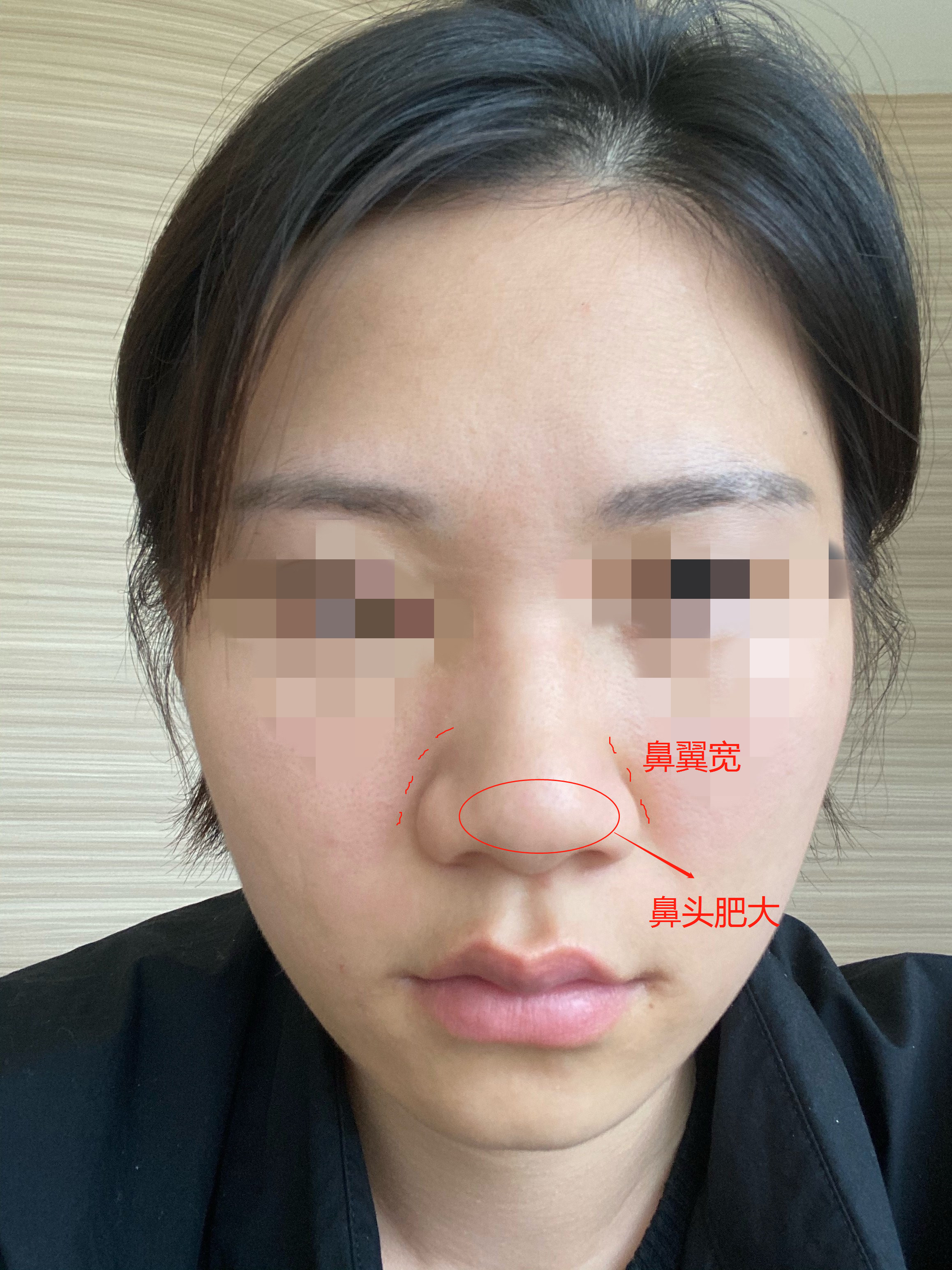 TACの鼻整形が人気の秘密｜症例写真・ビフォーアフター｜美容整形･美容外科のTAクリニックグループ