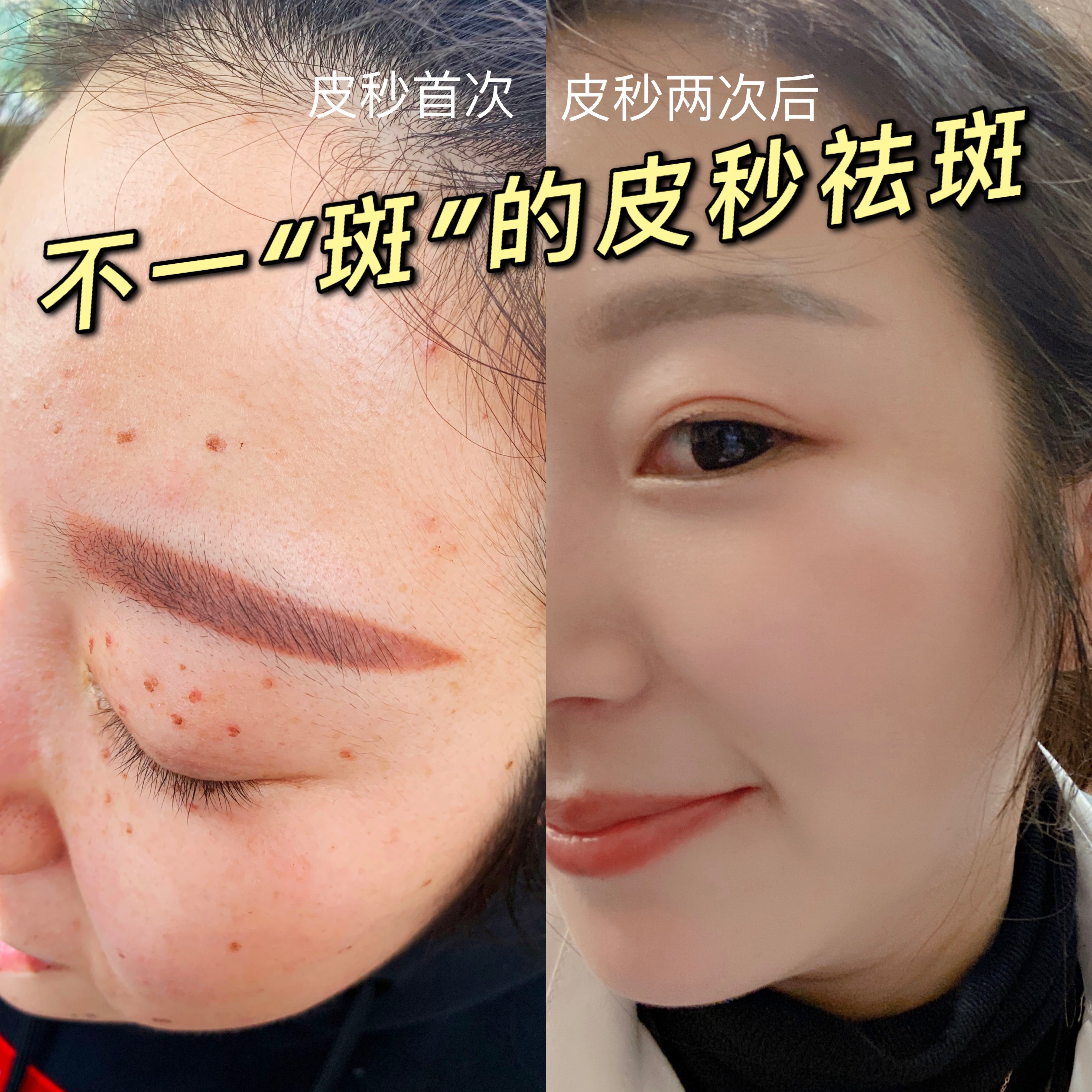 皮秒祛斑让你美的不一"斑"