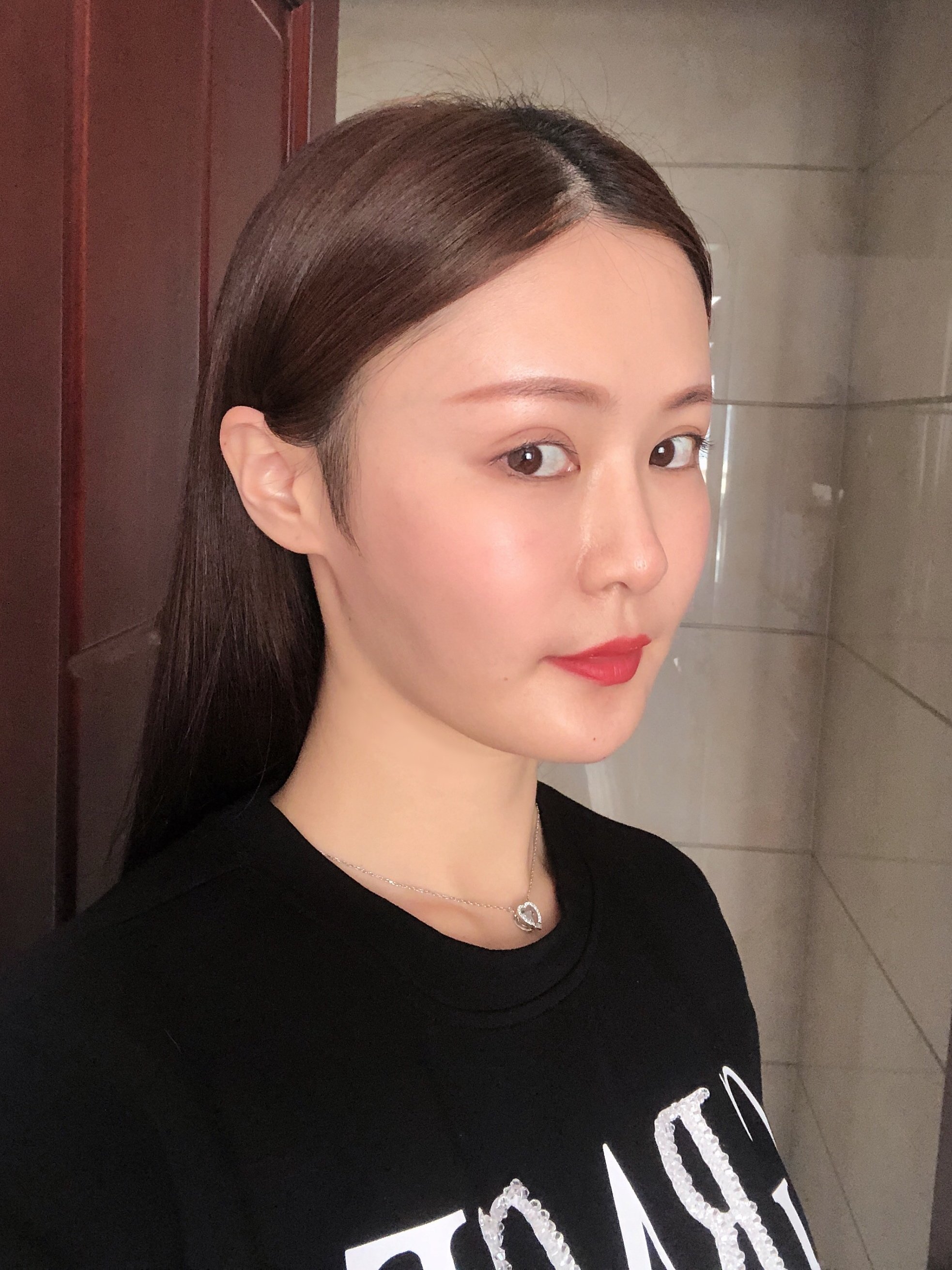 【术前诊断】u型脸.太阳穴凹陷,苹果肌下垂,脸颊轻_圈子-新氧美容整形