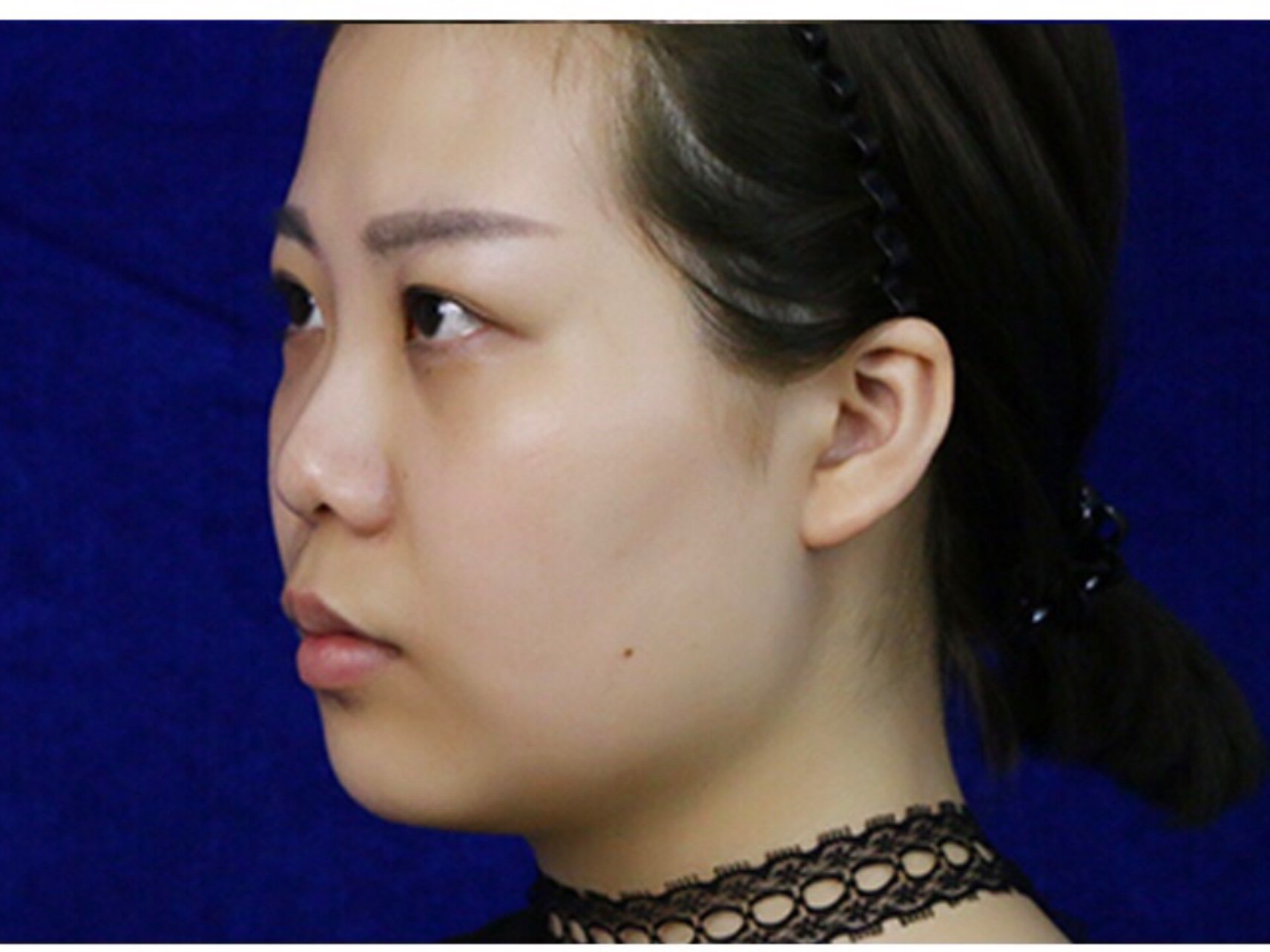 求美者术前鼻子山根鼻背低平鼻头鼻翼肥大鼻尖较短