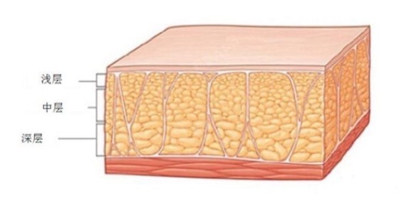 严格的说我们的脂肪层分三层:浅层脂肪,中层脂肪,深层脂肪.1.