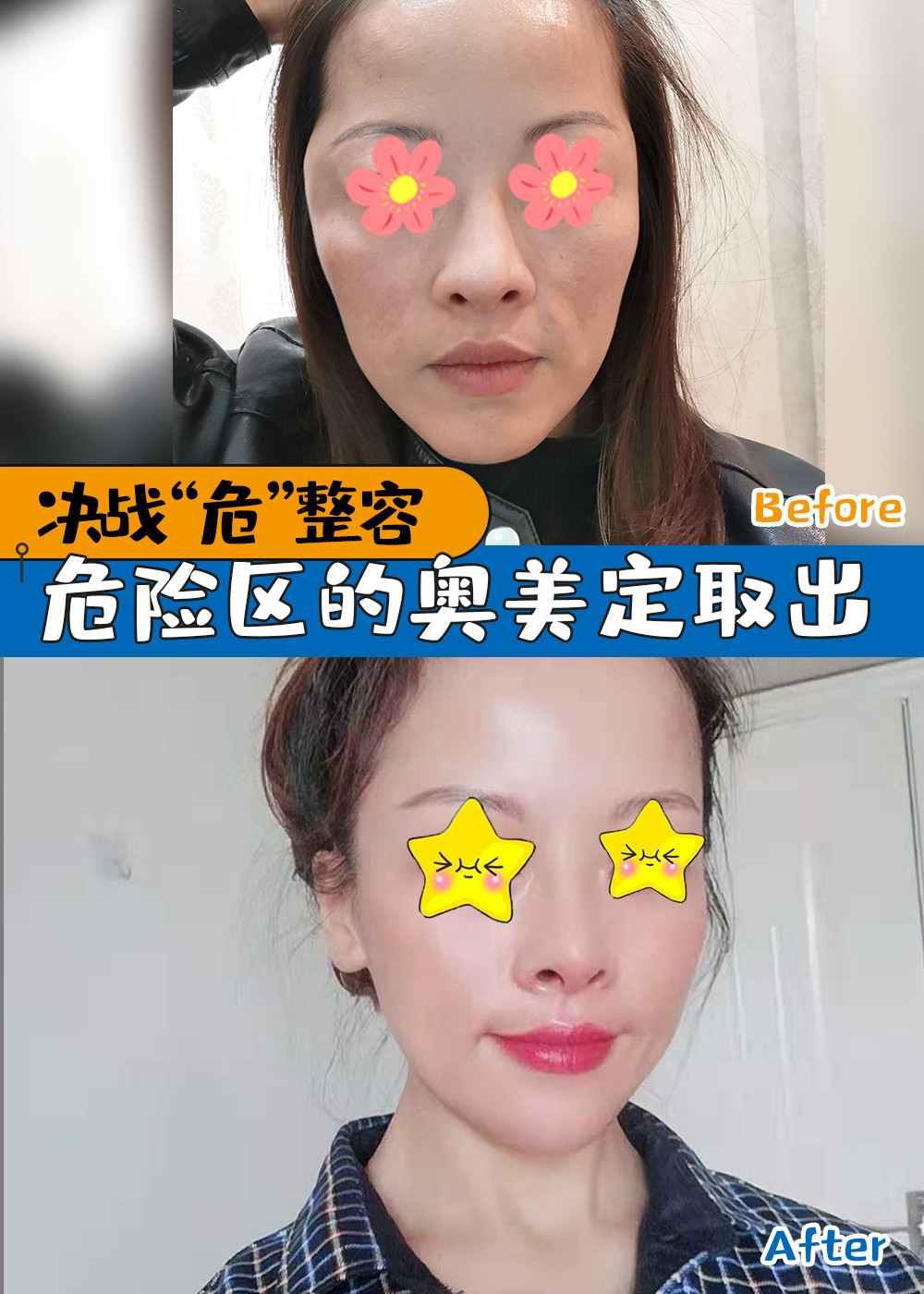 决战"危"整容危险区的奥美定取出