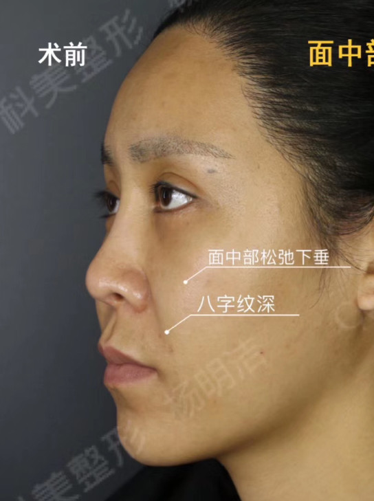 鼻翼高度不一致,八字纹比较深,组织下垂松弛